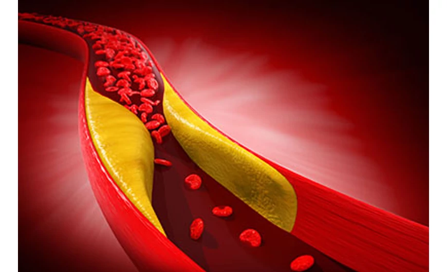 Az érszűkület jelei, tünetei és az érszűkület kezelése